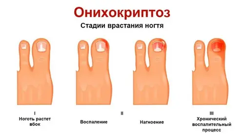 Onychocryptose stadia van nagel ingroei